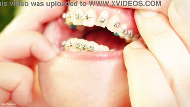 giro della bocca con lapparecchio - vore fetish - primo piano - 10 image