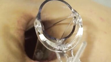 Elmers Wife Anal fisting speculum trois - 4 image